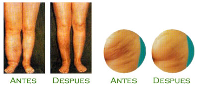 Resultados Hidrolinfa